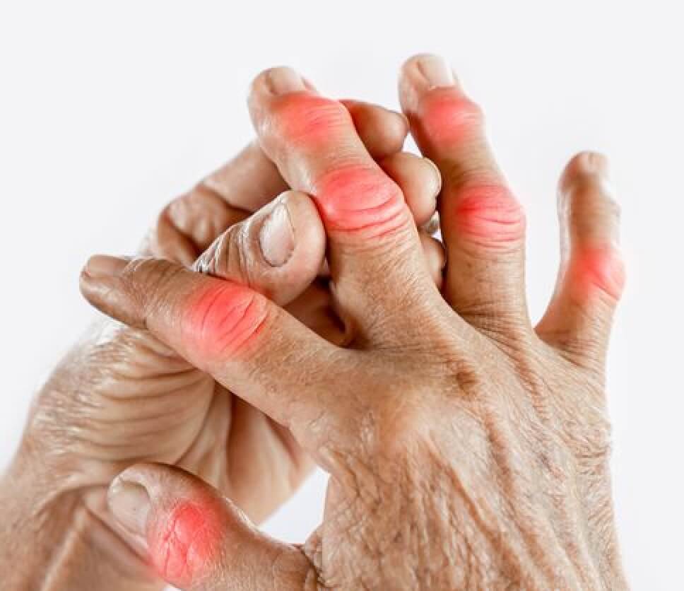 arthritis pain relief