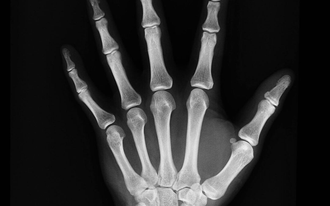 Does Arthritis Damage the Joints?